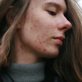 Sua pele já afetou seus relacionamentos?